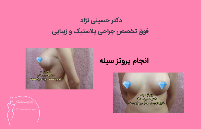 جراحی پروتز سینه دکتر حسینی نژاد
