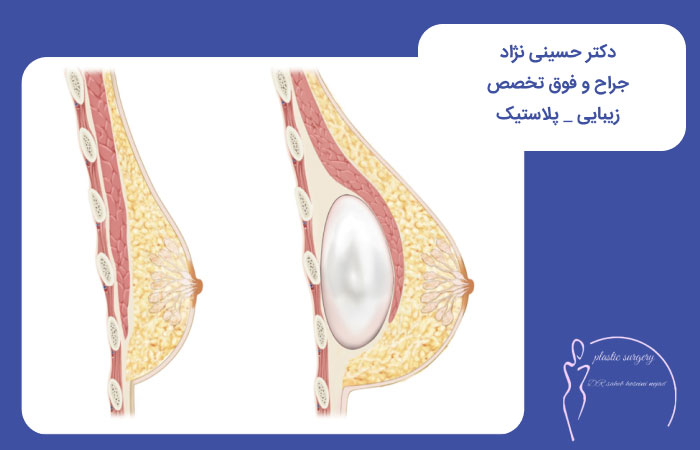 نمایی از گذاشتن پروتز در پستان