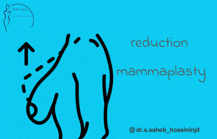 عمل کاهش حجم سینه در اهواز