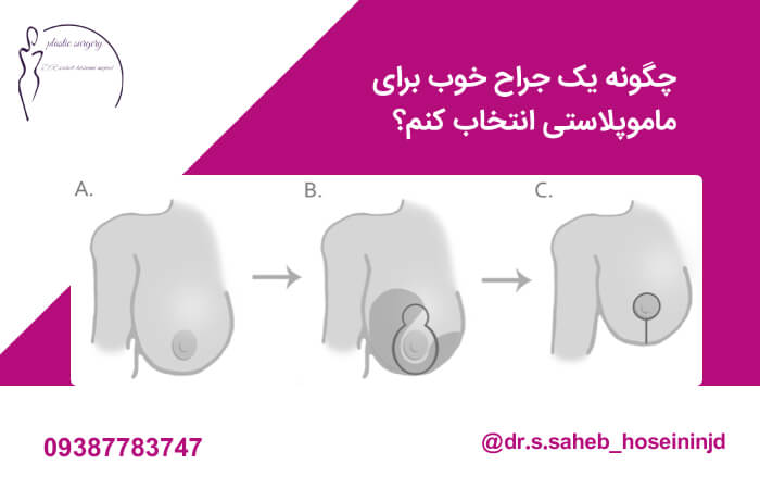 بهترین جراح ماموپلاستی