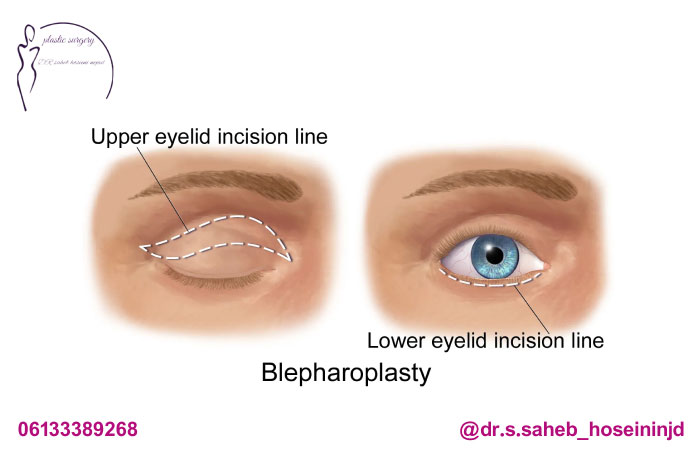 جراحی-بلفاروپلاستی-بالا-و-پایین