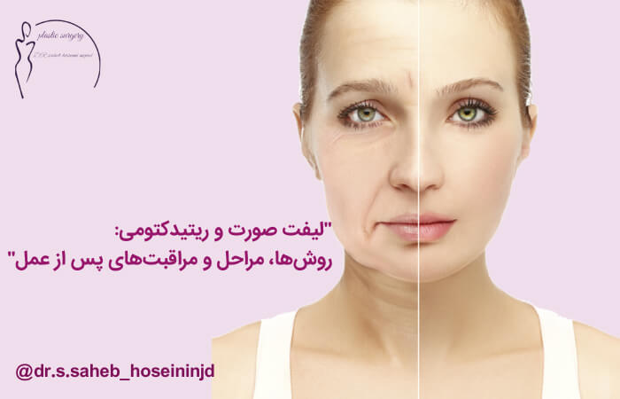 جراحی لیفت صورت یا ریتیدکتومی