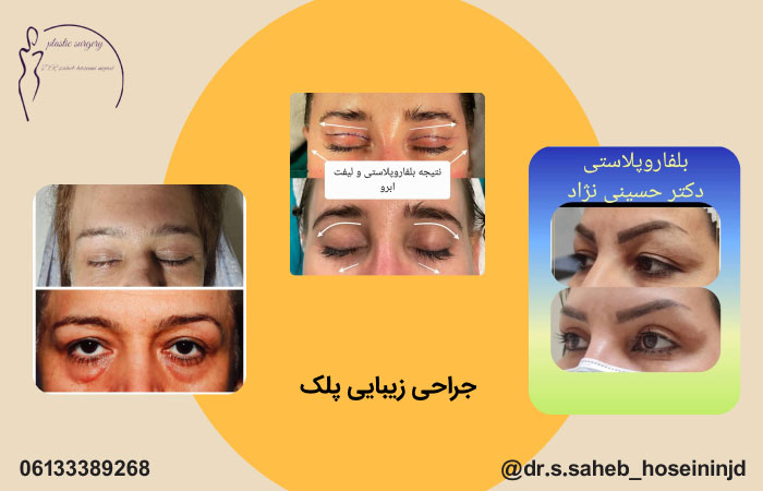 جراحی پلک در اهواز