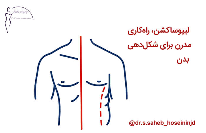 لیپوساکشن در مردان