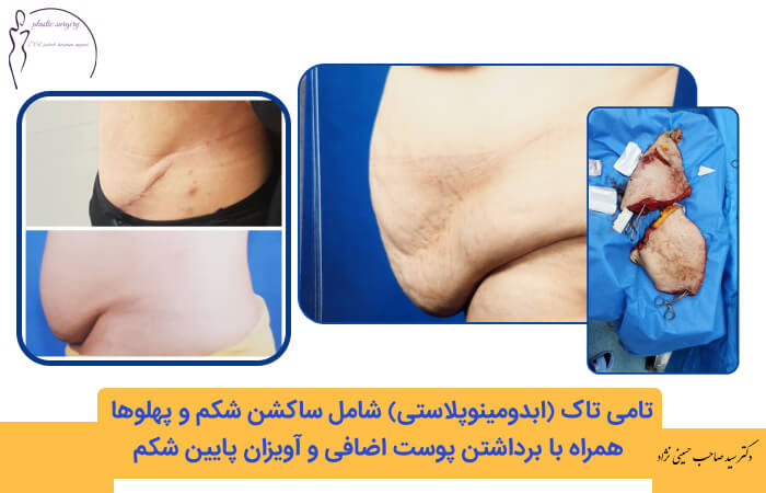 نمونه کار جراحی شکم 