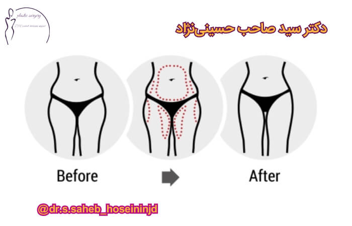 کنتورینگ بدن در اهواز