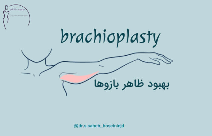جراحی براکیوپلاستی