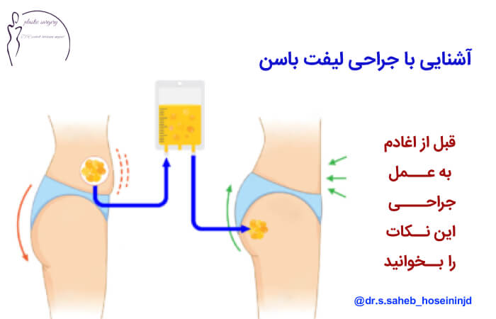 جراحی لیفت باسن برزیلی در اهواز