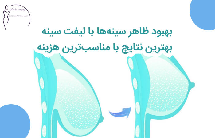جراحی ماستوپکسی