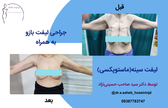 نمونه کار جراحی لیفت سینه در اهواز