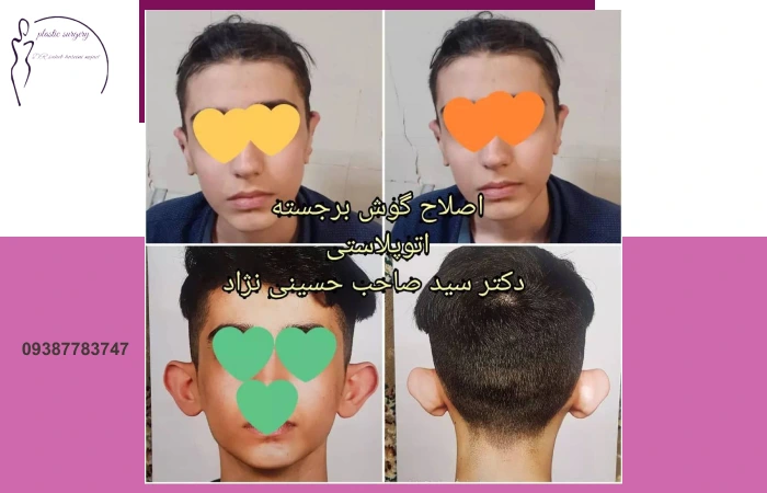 اصلاح گوش برگشته