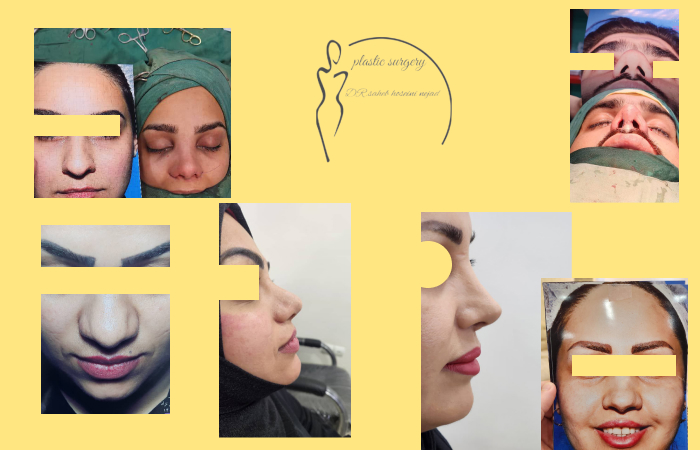 نمونه کار جراحی بینی گوشتی