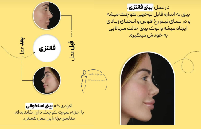 مدل بینی فانتزی