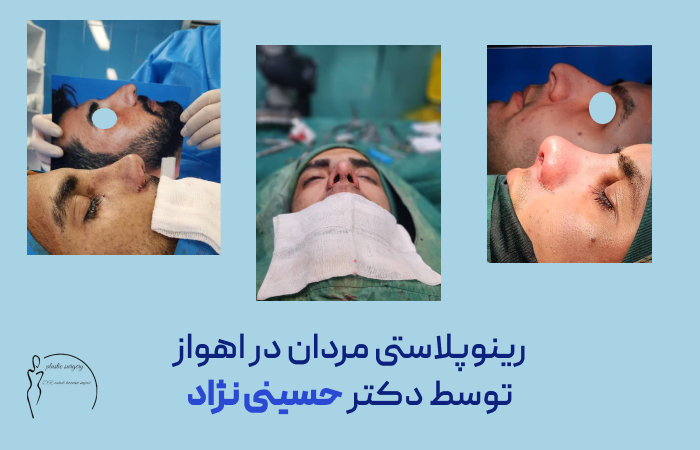 رینوپلاستی مردان