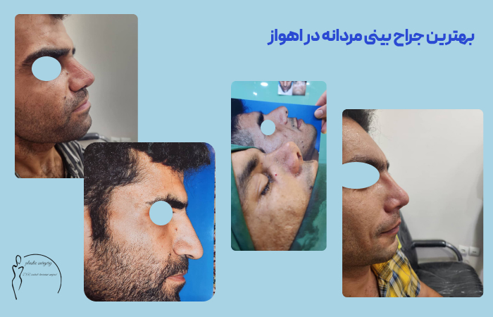 نمونه کار جراحی بینی برای مردان در اهواز
