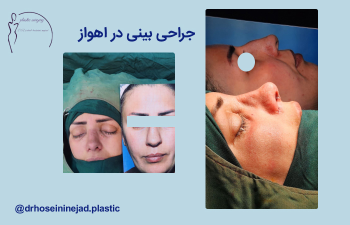 جراحی ترمیمی بینی در اهواز
