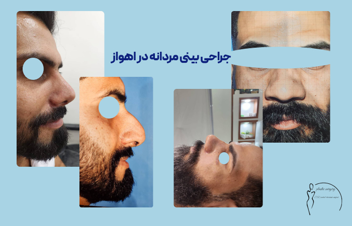 جراحی بینی در مردان