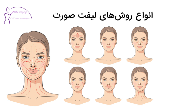 روشهای لیفتینگ صورت