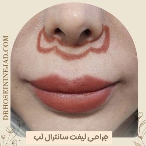 Central-Lip-Lift
