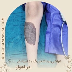 Congenital-Melanocytic-Nevus-Removal-5