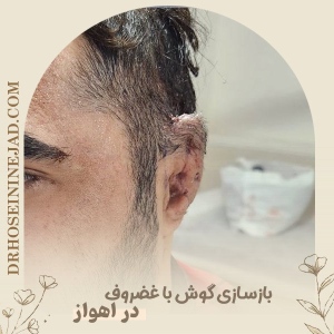 Ear-Reconstruction-2