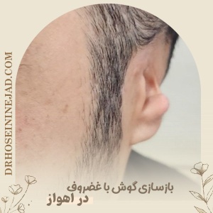 Ear-Reconstruction-3