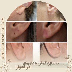 Ear-Reconstruction-5