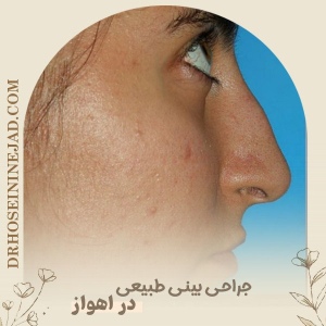 Natural-Rhinoplasty-2