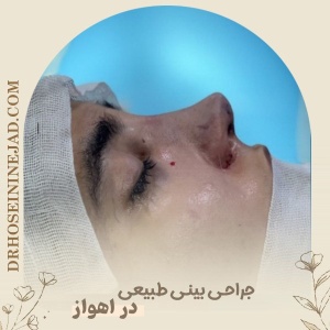 Natural-Rhinoplasty