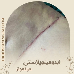abdominoplasty3