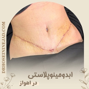 abdominoplasty4