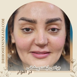 forehead-lift-2-1