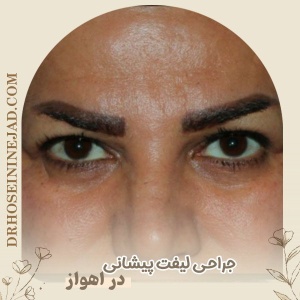forehead-lift5