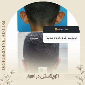 otoplasty-2