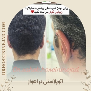 otoplasty