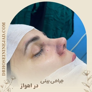 rhinoplasty4