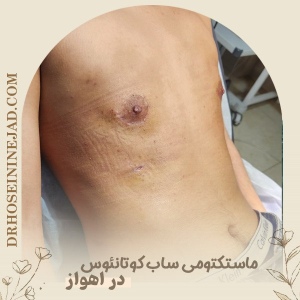 subcutaneous-mastectomy-3-1