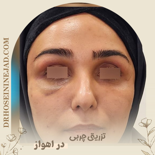 تزریق چربی در اهواز - دکتر حسینی نژاد