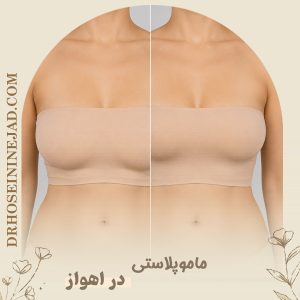 ماموپلاستی - دکتر حسینی نژاد