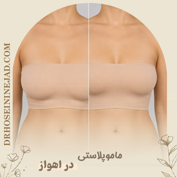 ماموپلاستی - دکتر حسینی نژاد