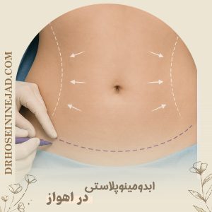 ابدومینوپلاستی در اهواز - دکتر حسینی نژاد