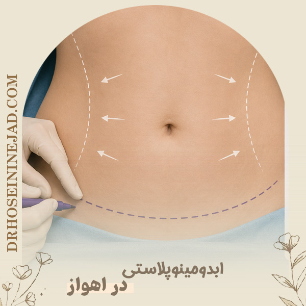 ابدومینوپلاستی در اهواز - دکتر حسینی نژاد