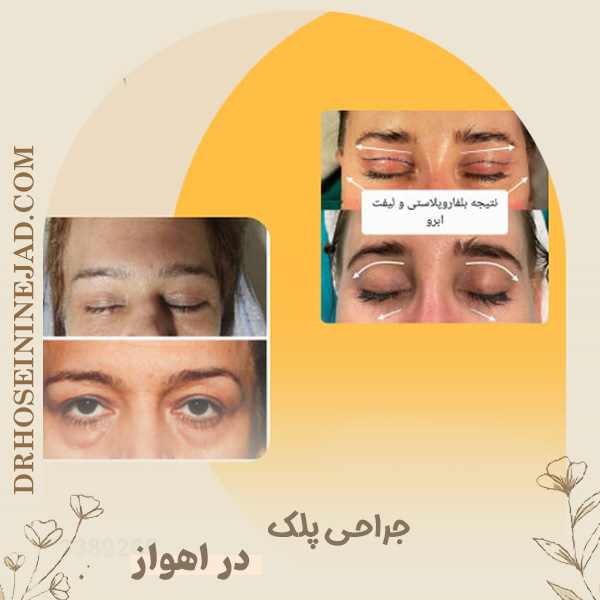 جراحی پلک در اهواز - دکتر حسینی نژاد