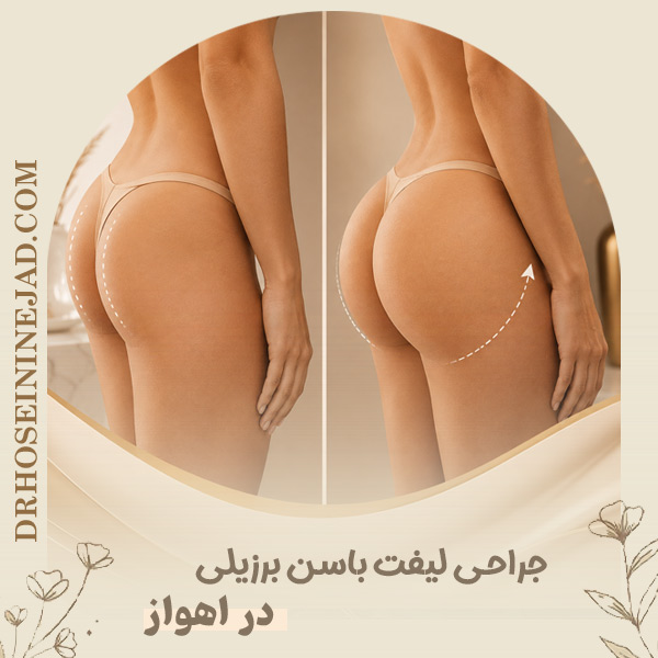 جراحی لیفت باسن برزیلی - دکتر حسینی نژاد