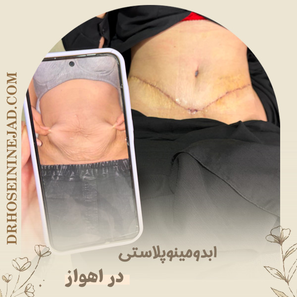 جراح ابدومینوپلاستی - دکتر حسینی نژاد