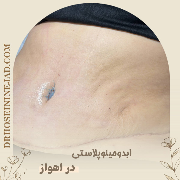 جراح ابدومینوپلاستی - دکتر حسینی نژاد