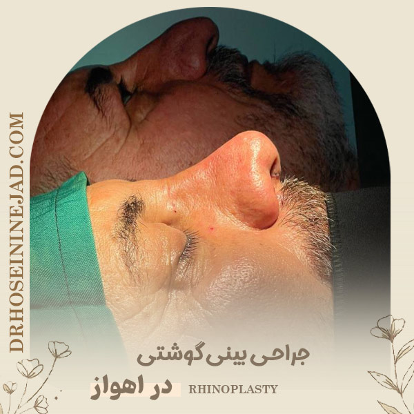 جراحی بینی گوشتی - دکتر حسینی نژاد