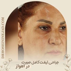 لیفت صورت در اهواز  - دکتر حسینی نژاد