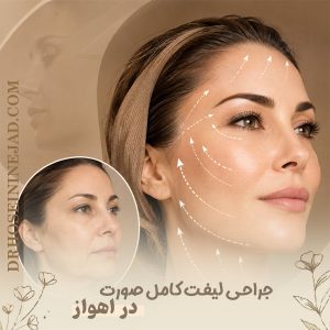 لیفت صورت در اهواز