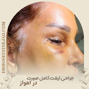 لیفت صورت در اهواز  - دکتر حسینی نژاد